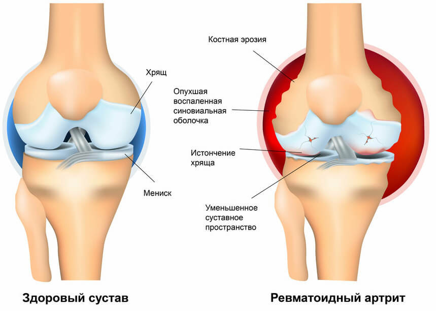 Почему появляется боль в коленном суставе? | Блог о здоровье