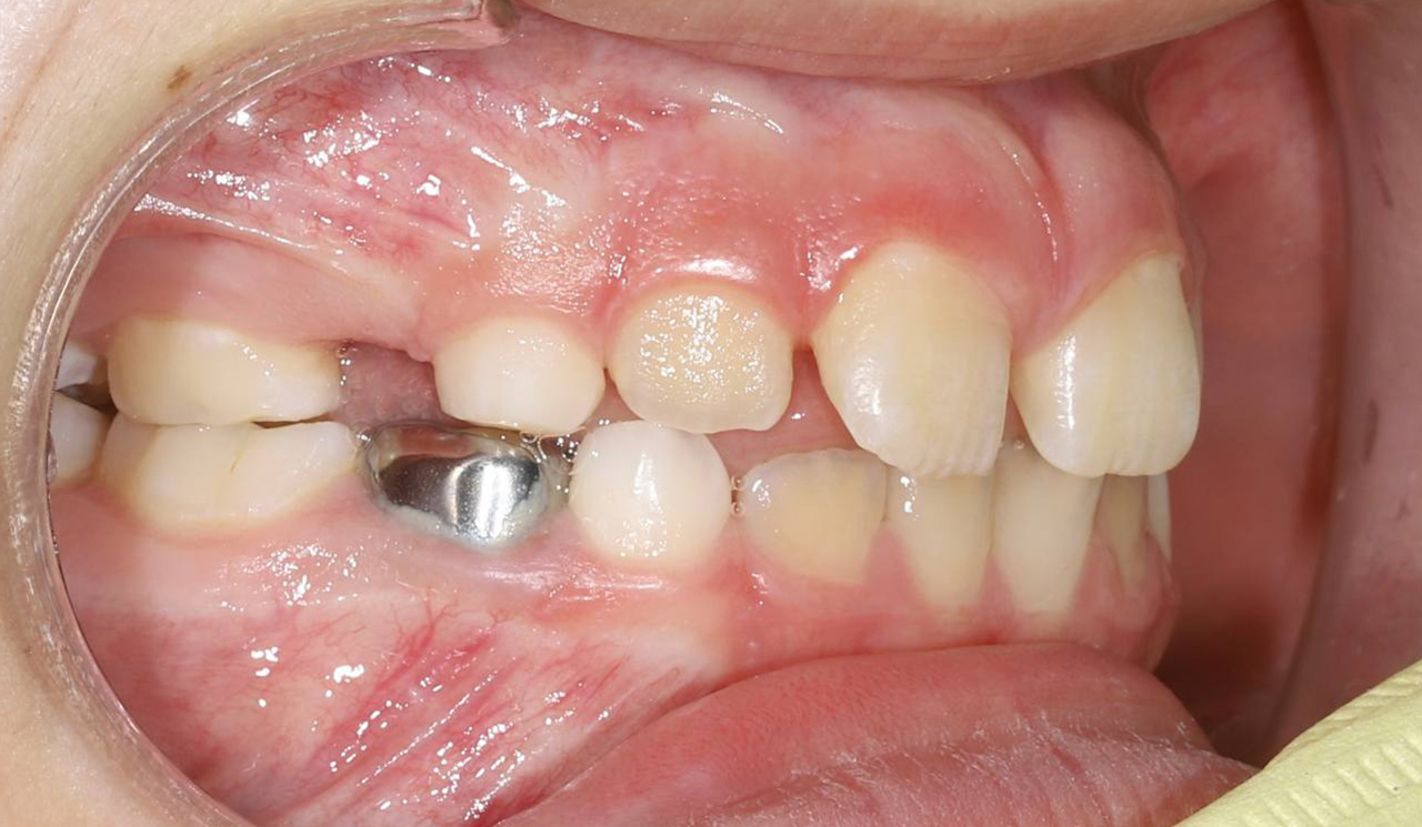 Исправление неправильного прикуса в раннем возрасте