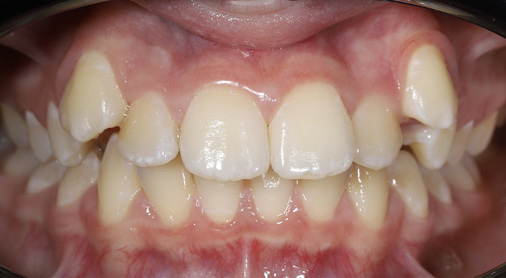 Исправление неровных зубов и недостатка места для зубов у подростка