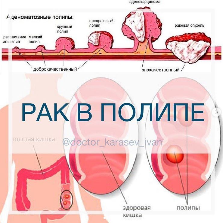 Операция по удалению полипов в горле - лечение в Москве
