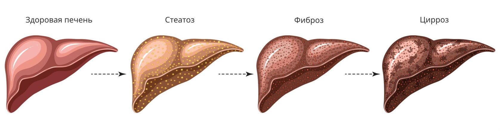 Жировой гепатоз и цирроз