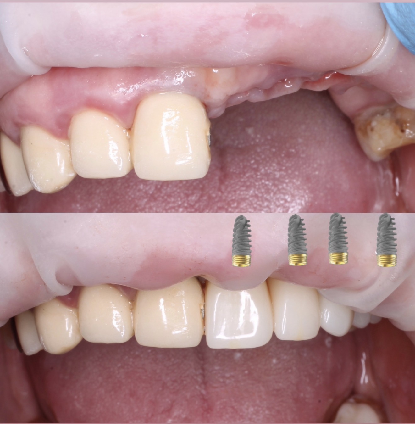имплантация зубов в Чебоксарах,Йошкар-оле,имплантация,акция на имплантацию зуба,рассрочка на имплантацию