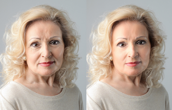 Подтяжка лица 45+: до и после