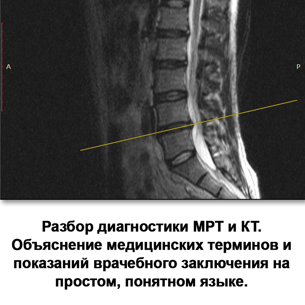 Фото разбор диагностики МРТ и КТ. Объяснение медицинских терминов и показаний врачебного заключения на простом, понятном языке. Показываю размер межпозвоночной грыжи. Размер протрузии. Сужение спинномозгового канала. Угол искривления, сколиоз.