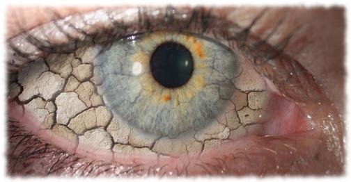Сухой глаз