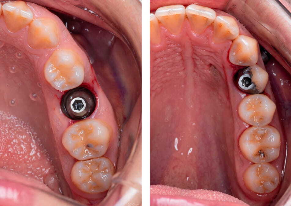 Мягкие ткани вокруг импланта