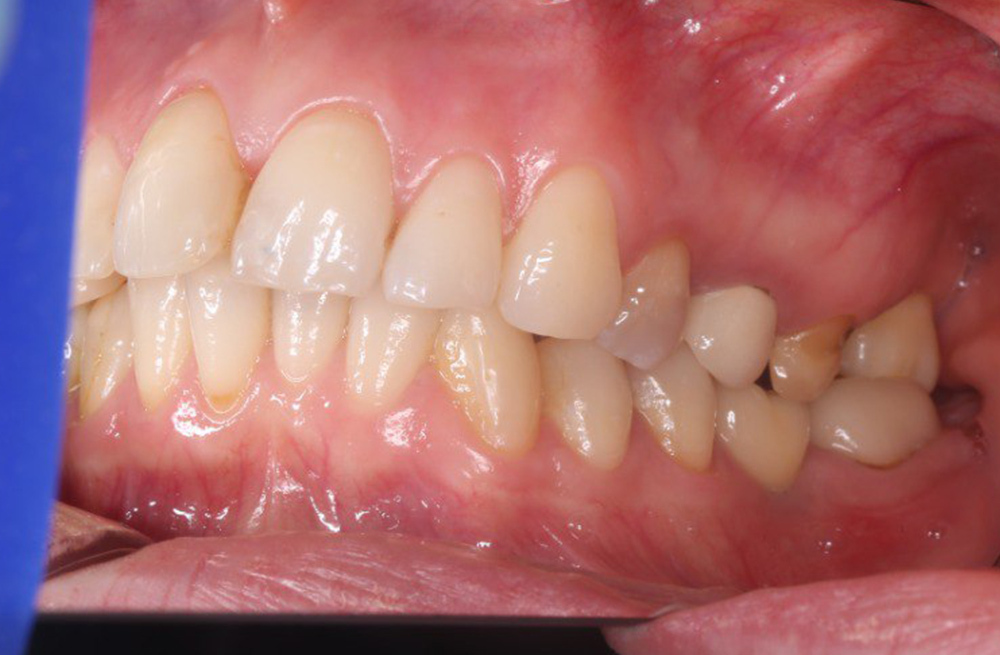 Решение эстетической проблемы 15 зуба с одновременной имплантацией 16 зуба и протезированием