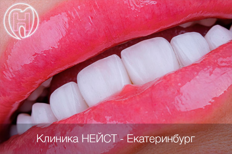 керамические виниры Екатеринбург цвет Блич 2 (Bleach 2)