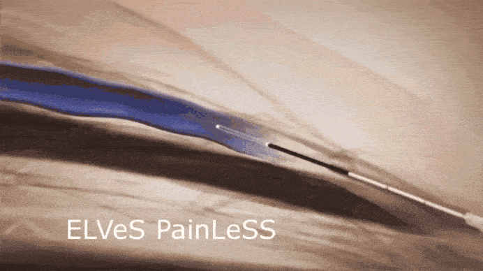 Как работает лазер