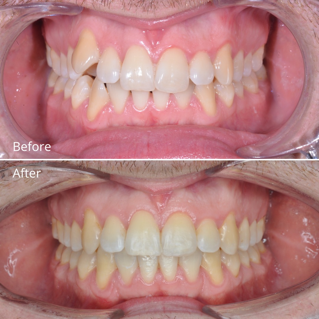Stage photo showing distalization progress with microimplant and VectorTAS mechanics — photo 2 of 3