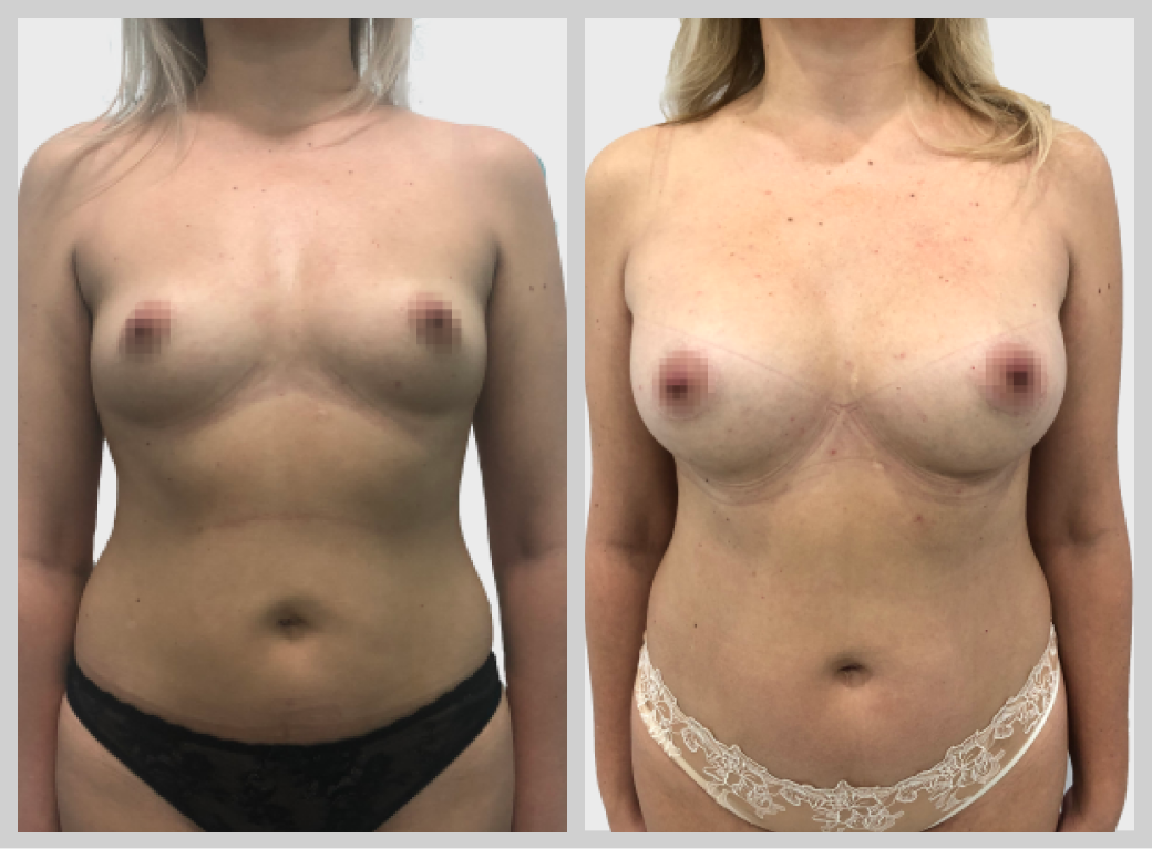 маммопластика увеличение груди импланты