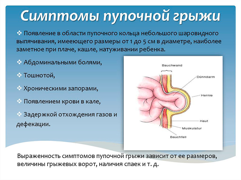 Грыжа живота: симптомы и признаки, диагностика, лечение