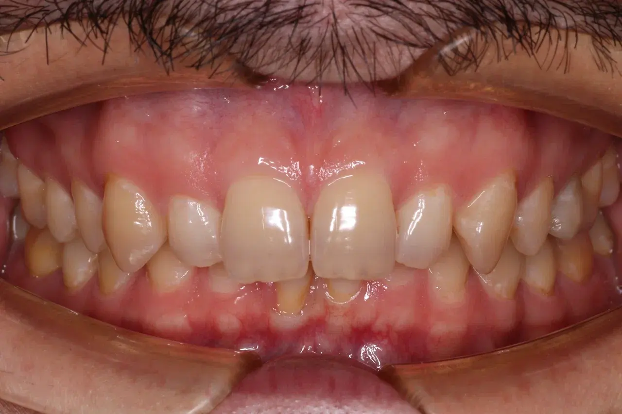 До лечения