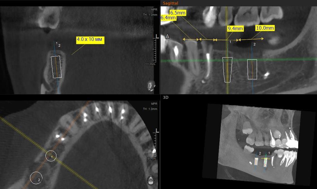 Кт для имплантации