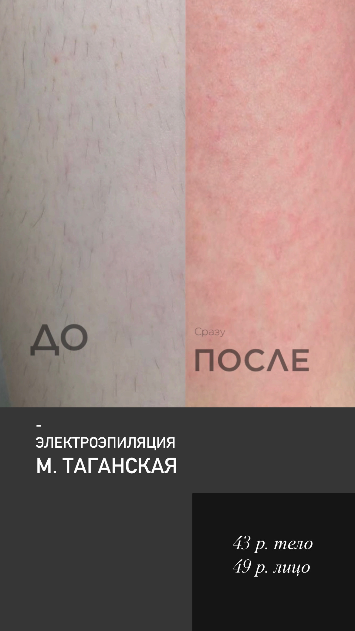 Электроэпиляция в Москве в клинике Effect Epil