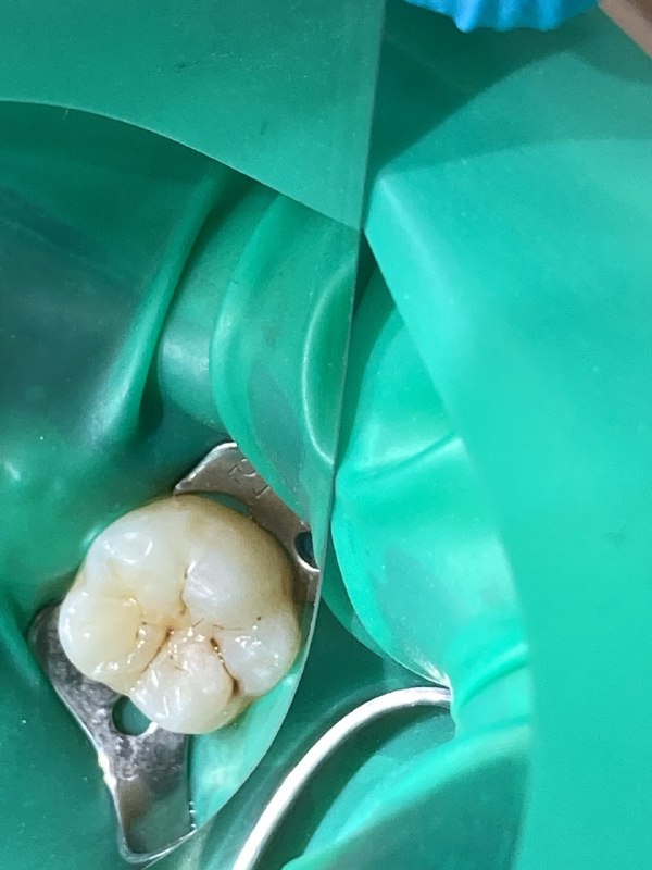 отпрепарирован зуб, убран весь кариозный процесс