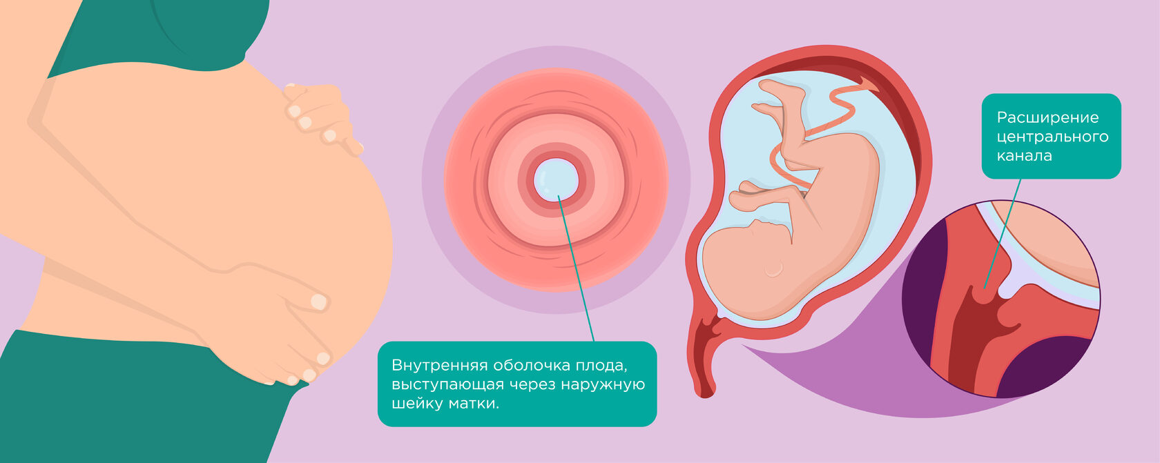 Почему сокращается шейка матки во время беременности: причины и последствия