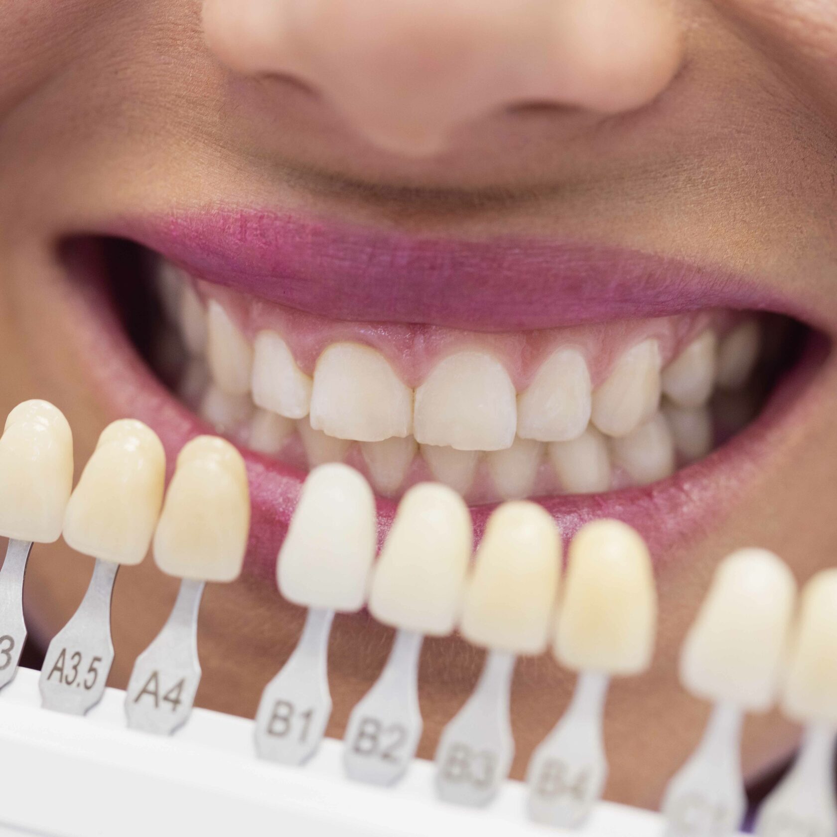 Методы отбеливания зубов. Естественный цвет зубов. Естественный цвет зубов у человека. Цвет виниров.