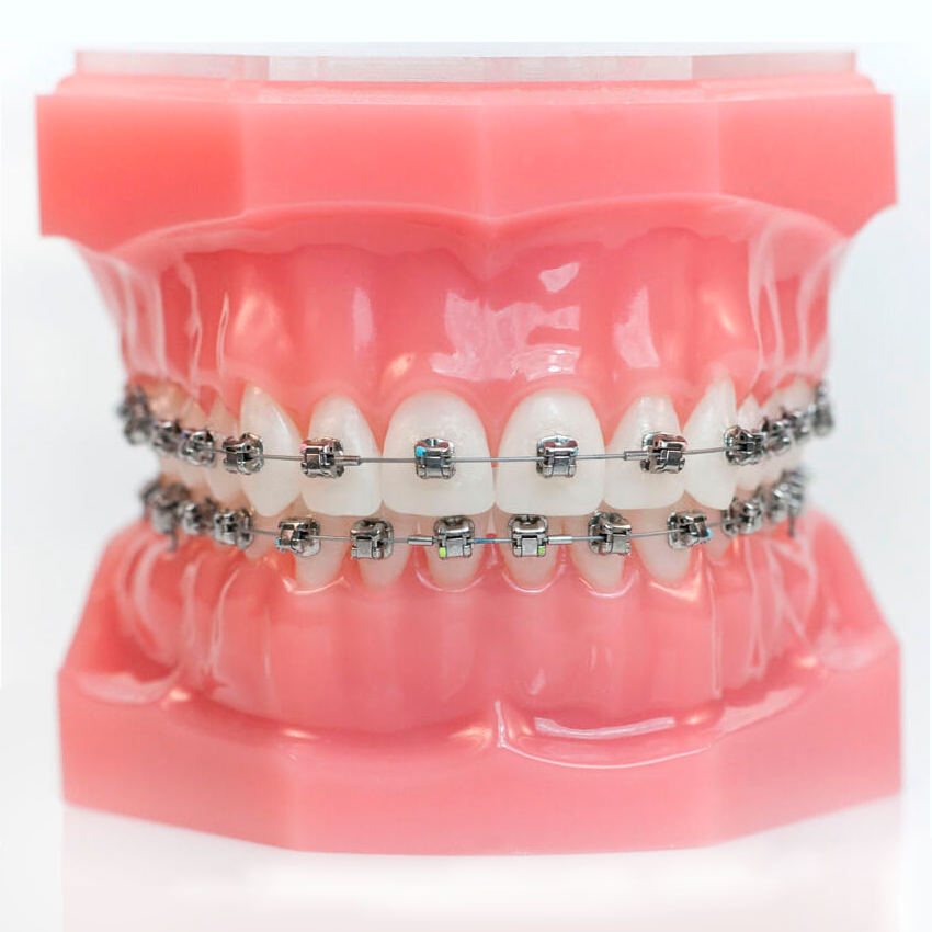 Установка безлигатурных брекетов в Дербенте. Брекеты Damon Q