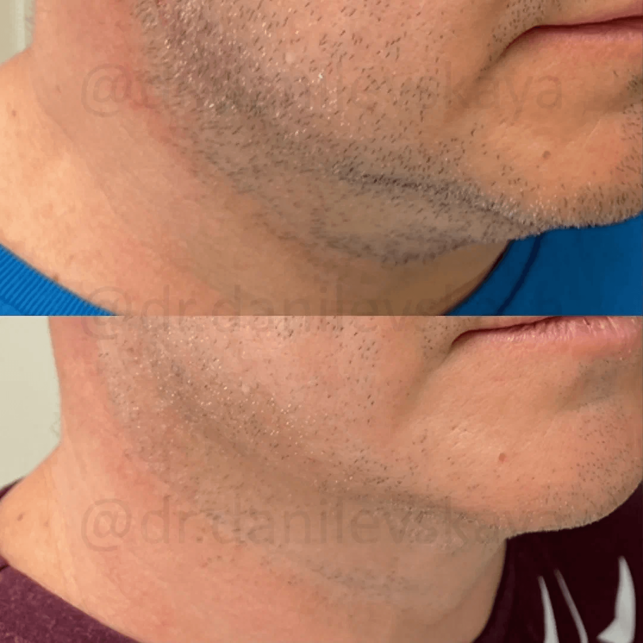 FaceTite до и после: коррекция второго подбородка у мужчины