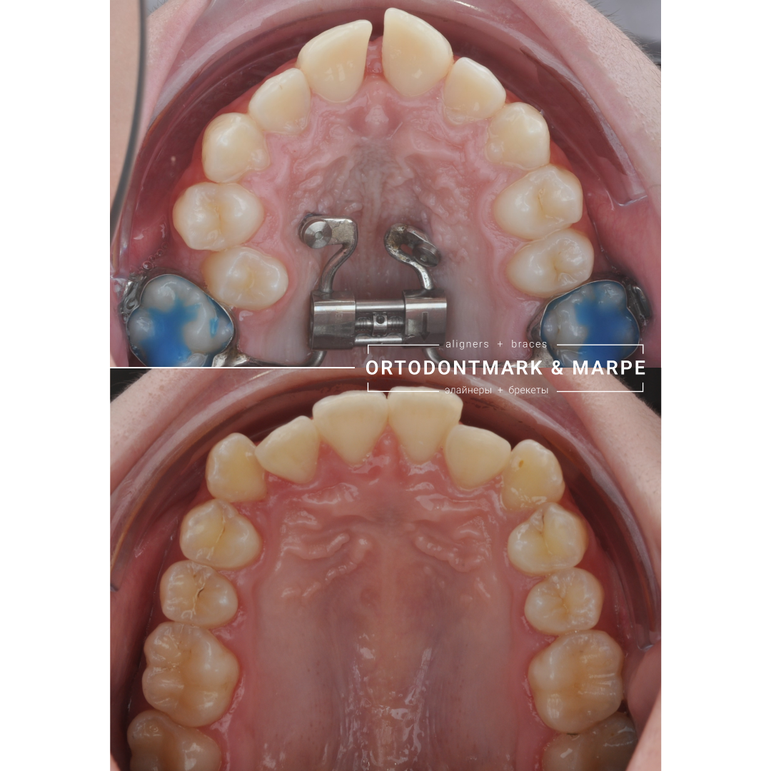 MARPE case result 13