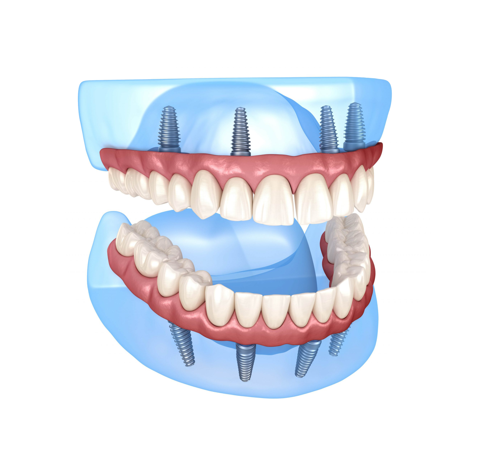 Имплантация зубов по технологии «all on 4». Имплантация челюсти на 4 имплантах.