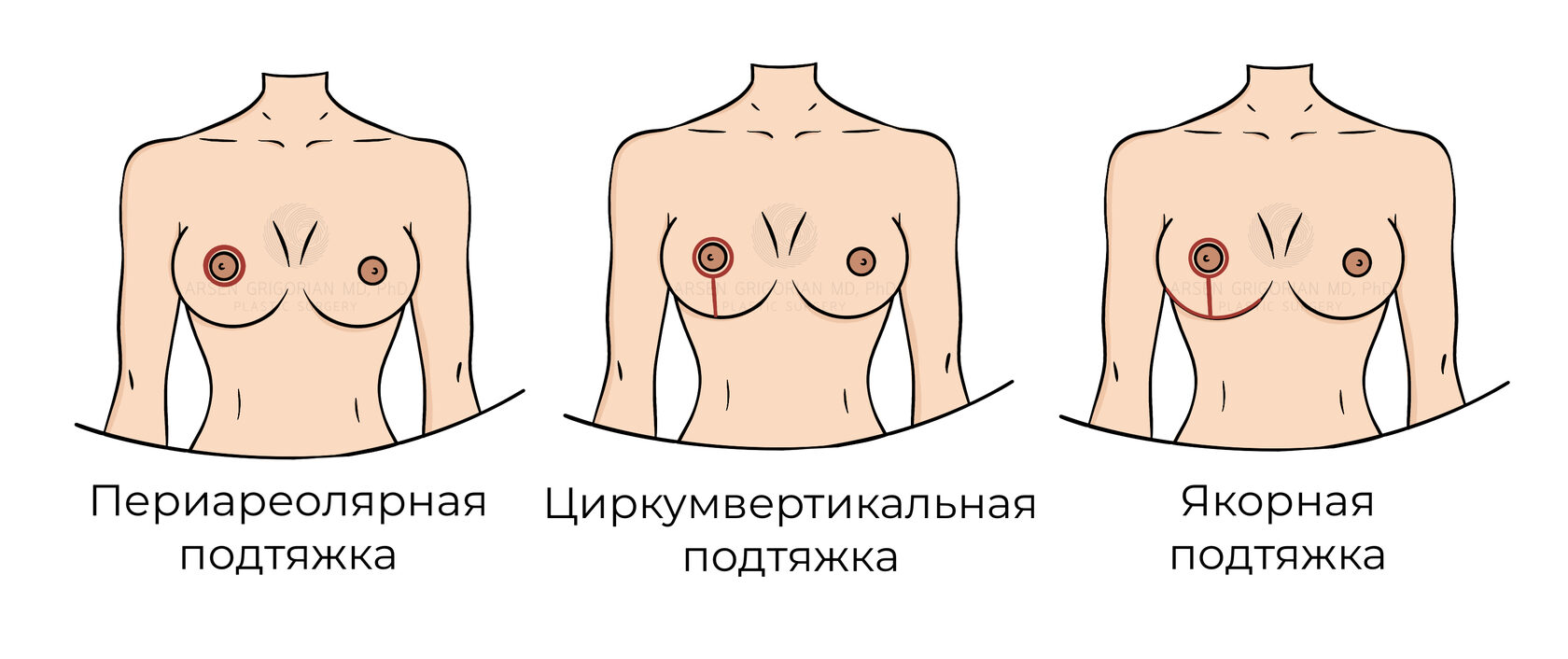 Подтяжка груди на имплантах