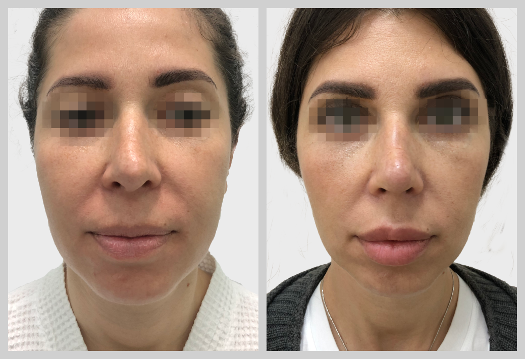 ринопластика пластическая хирургия