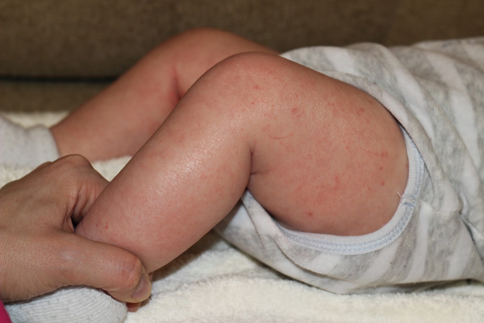 Атопический дерматит у детей - причины, симптомы диагностика и лечение в клинике «Будь Здоров»