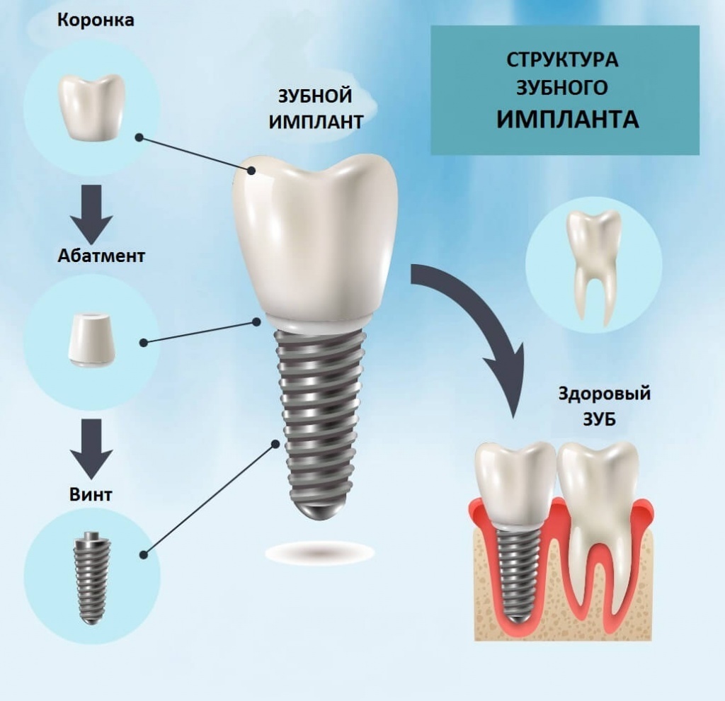 Схема импланта зуба