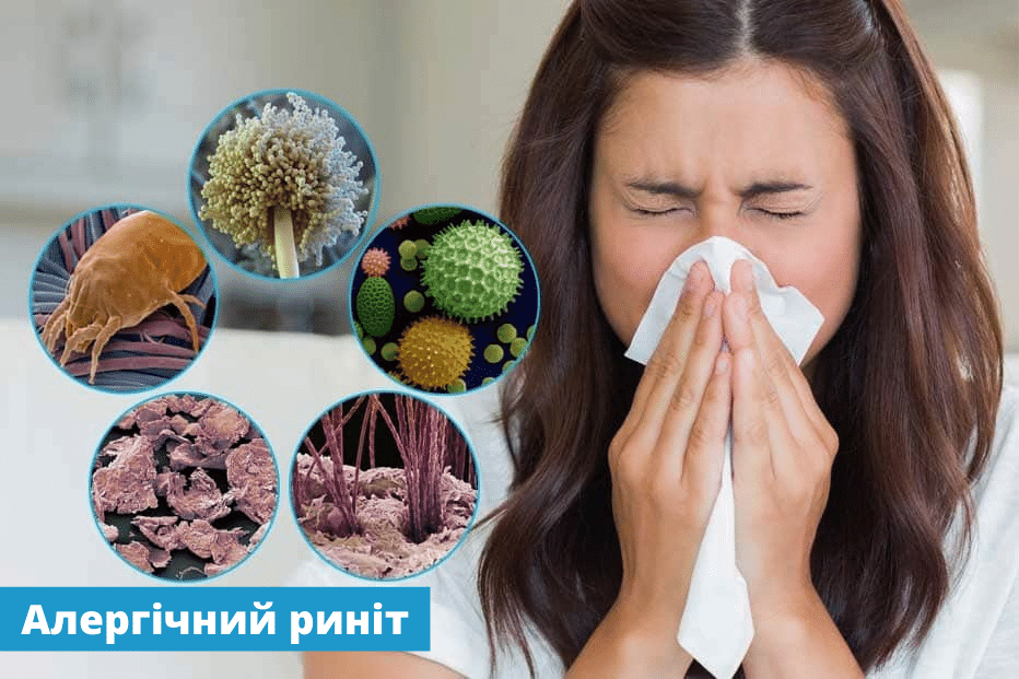 Лікування риніту у Львові (алергічний риніт, вазомоторний, інфекційний)