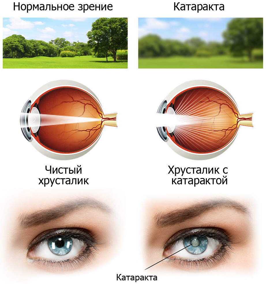 Атафракта. Хрусталик глаза. Что можно делать после катаракты