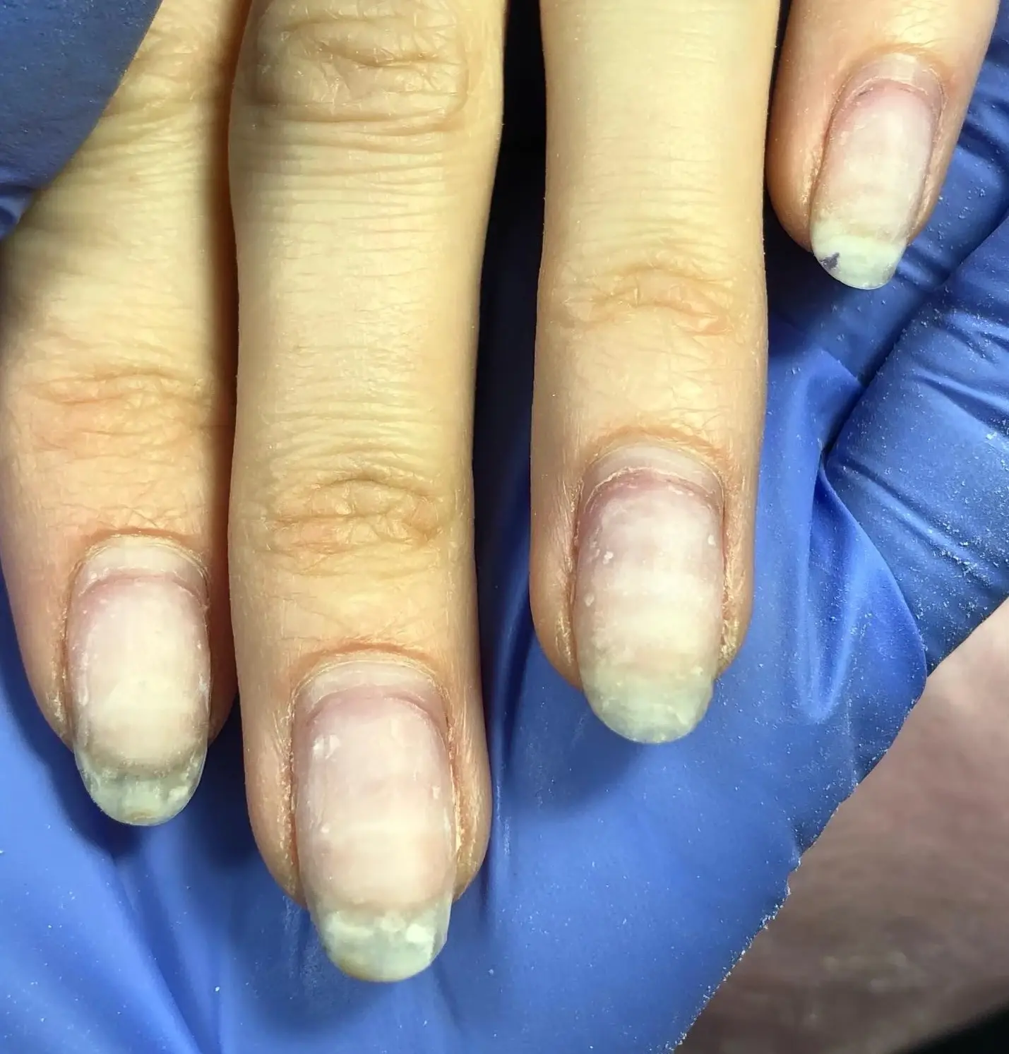 Пропилы на ногтях после аппаратного маникюра