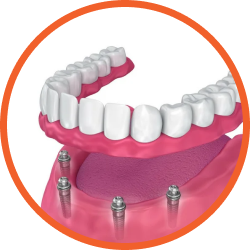 Установка имплантов в Дербенте. Имплантация при отсутствии одного зуба.