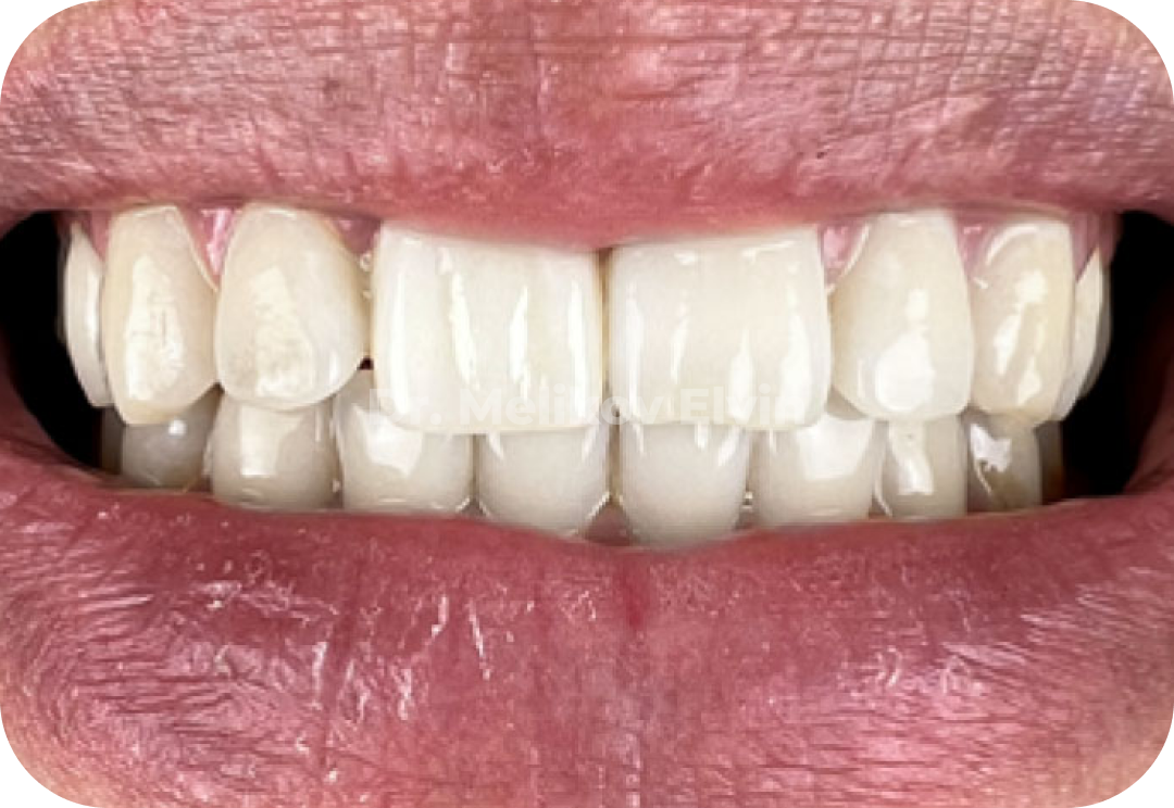 Одномоментная имплантация системой Штрауманн (Straumann) BLT.