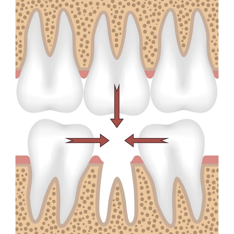 Схематичное изображение процессов смещения зубов после удаления