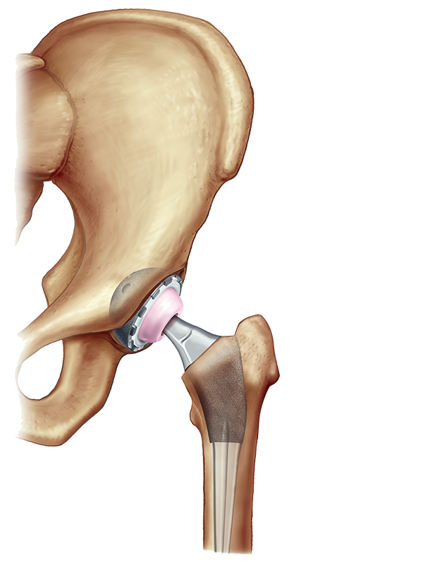 Эндопротез шейки бедра. Артропластика тазобедренного сустава. Эндопротез тазобедренного сустава femoral head. Искусственный сустав шейки бедра.