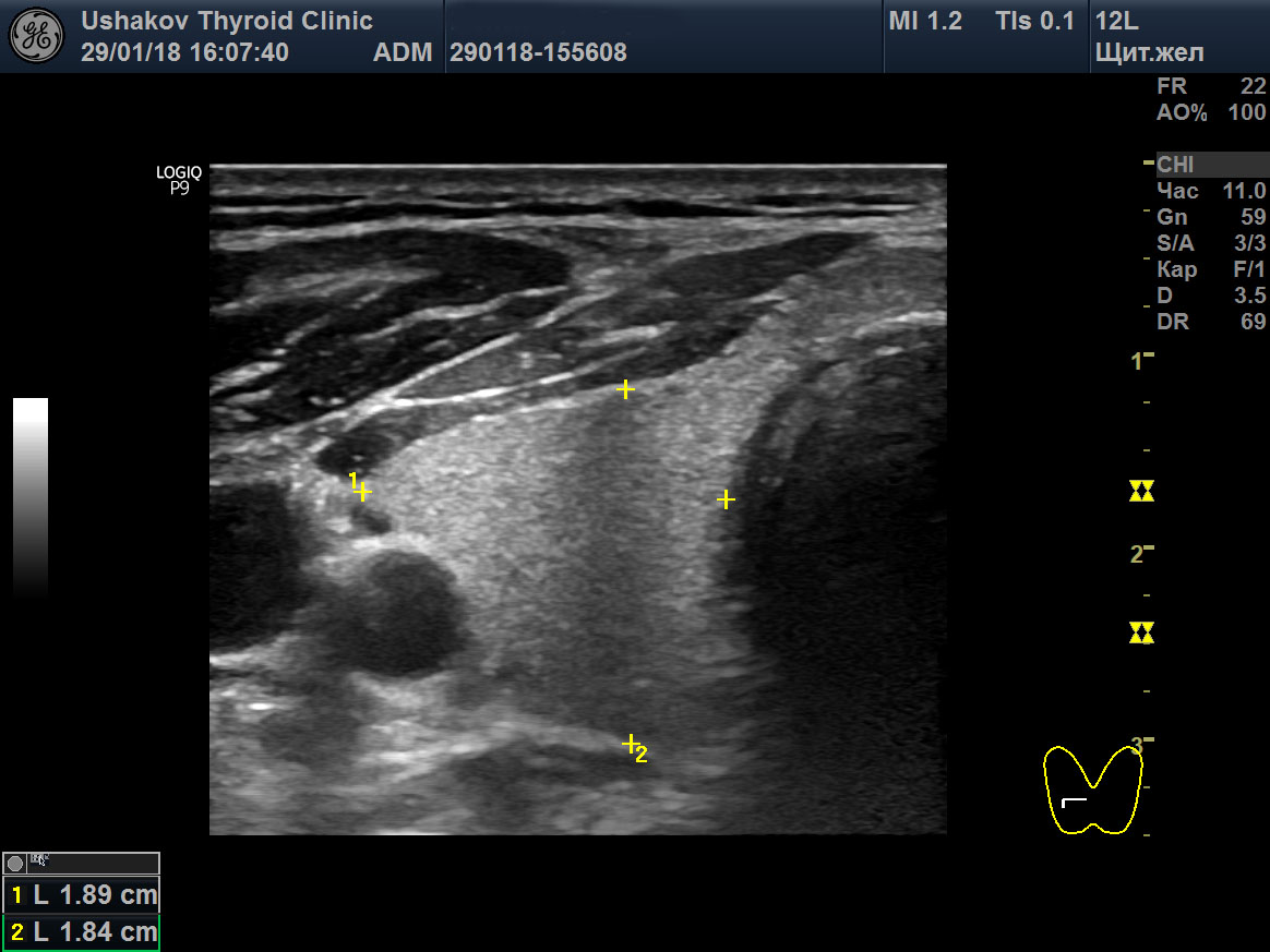Узи картина тиреоидита
