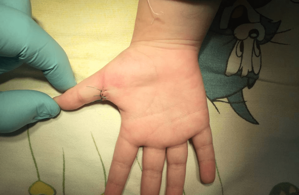Причины защелкивания пальца