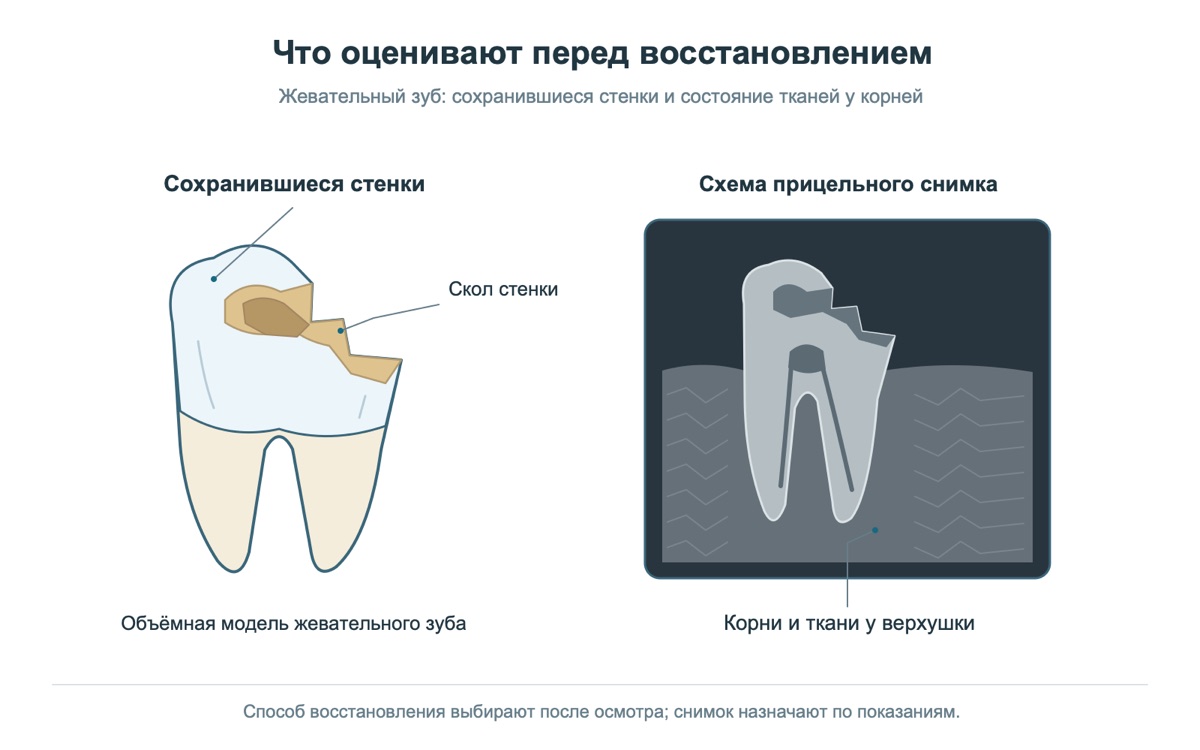 Модель жевательного зуба и прицельный снимок перед восстановлением