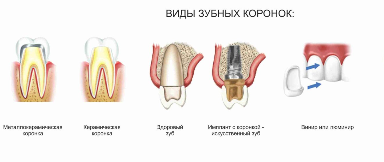 Как устанавливаютсякоронки на щубы. Коронка металлокерамика 6 зуб. Коронка на пульпитный зуб. Коронки на зубы из какого материала бывают. Коронки из каких материалов бывают