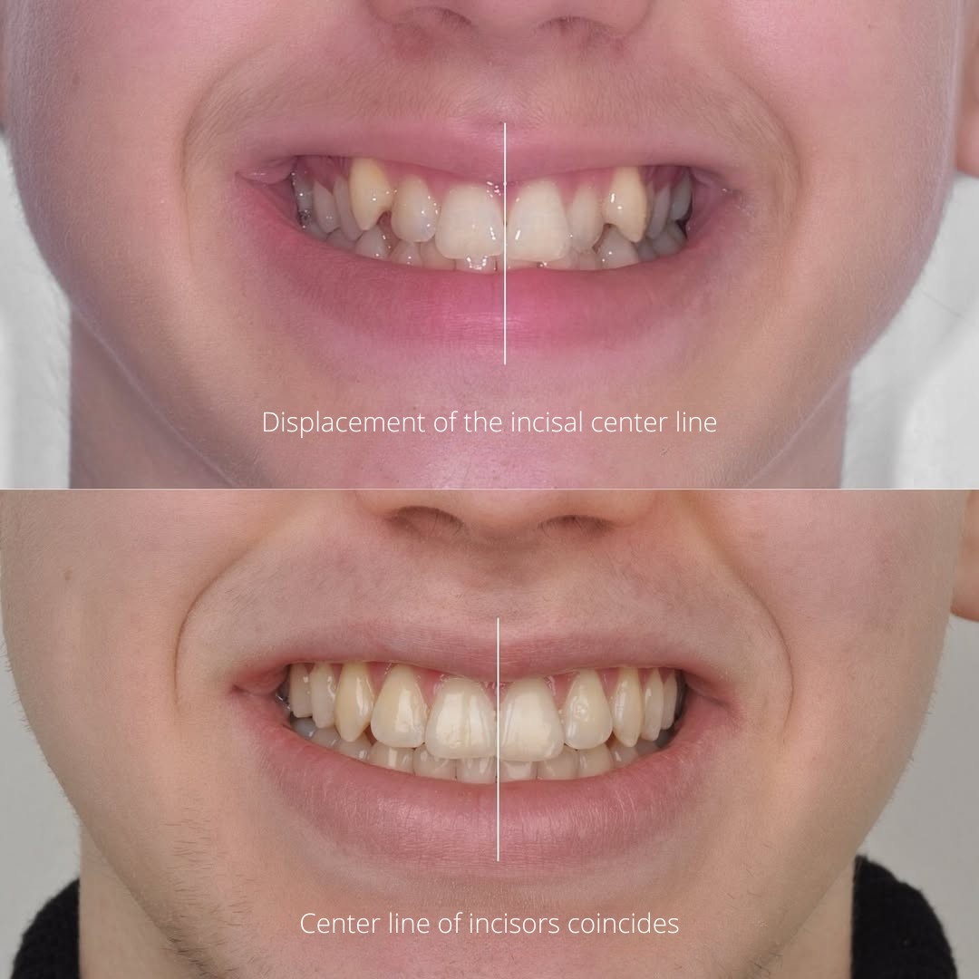 Detail view highlighting the disrupted smile arc before treatment — photo 2 of 3