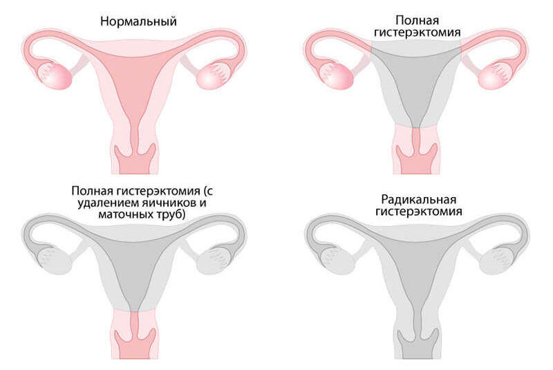 Удаление матки схема