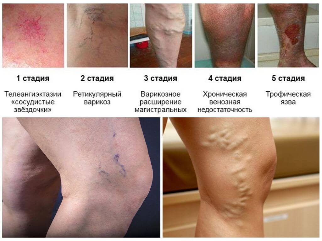 «Фото 1 стадии варикоза на ногах» «Расширенные вены на ногах — 2 стадия варикоза» «Трофические язвы при 4 стадии варикозной болезни