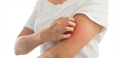 Как выглядят укусы клопов