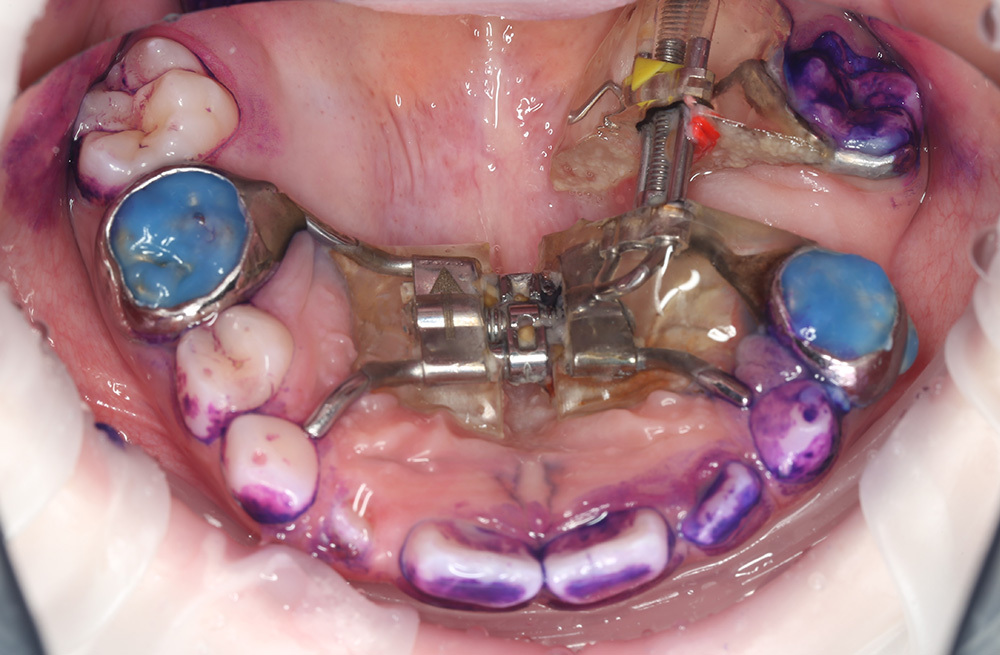 Эффективная чистка зубов с ортодонтическими конструкциями под контролем стоматолога