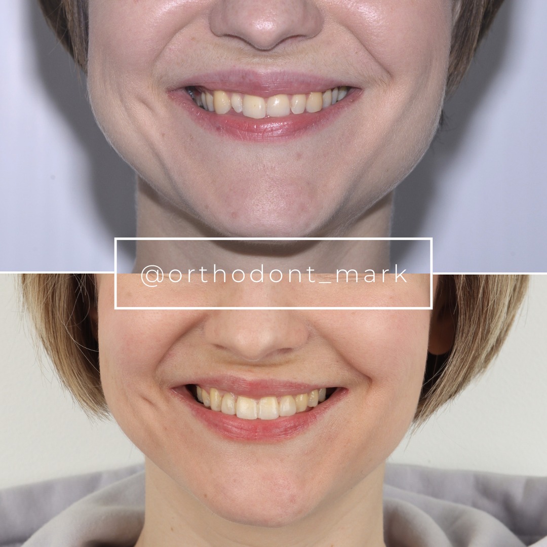 Before and after photo showing restored tooth shape, size, and smile alignment — photo 1 of 1