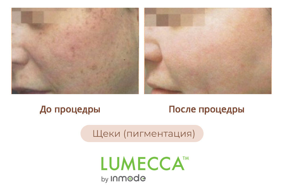 Фотоомоложение Lumecca