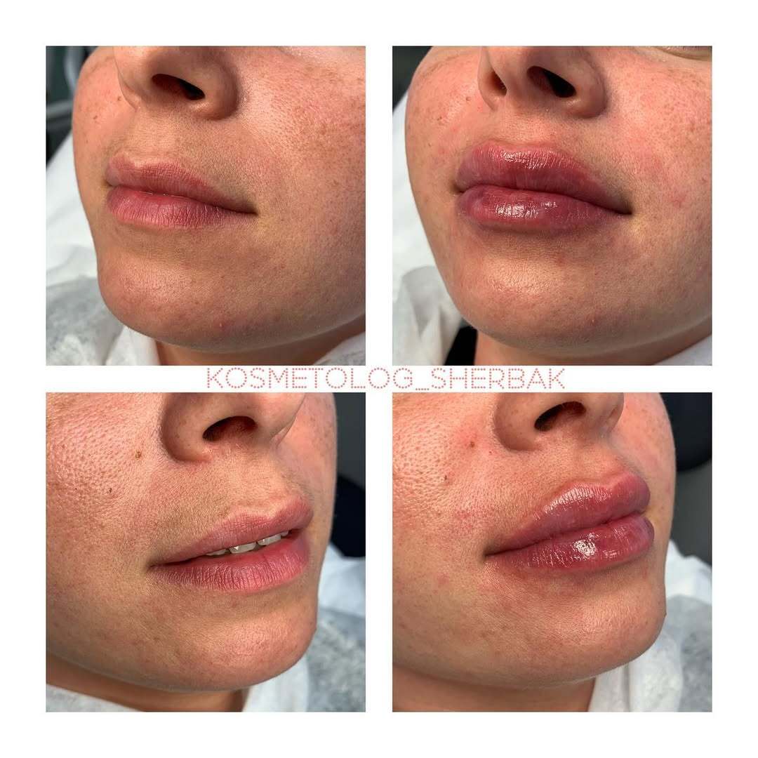 До и после контурной пластики губ. Увеличение объёма без утяжеления. PradusCOSMO, Васильевский остров