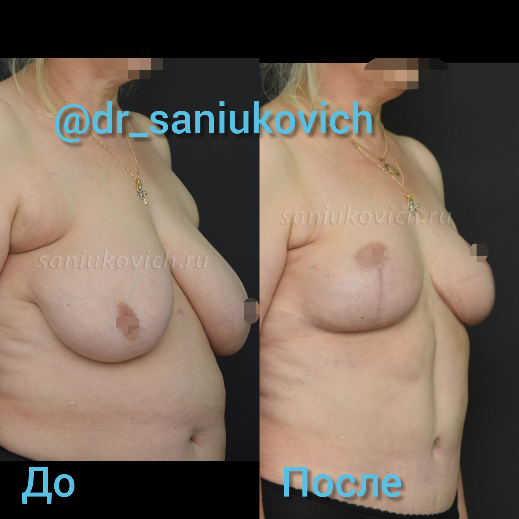 как проходит операция по уменьшению груди у женщин фото 90